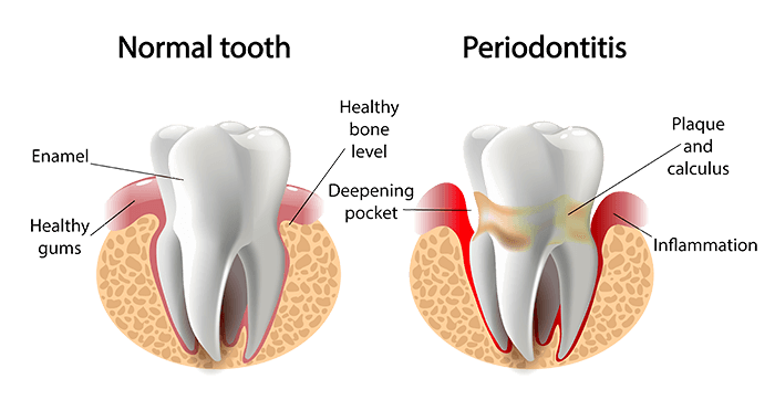 perio-protect-dentist-in-santa-maria-ca